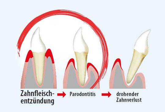 Itis-Protect® reduziert Entzündungen und beugt dadurch Parodontitis-bedingtem Zahnverlust vor
